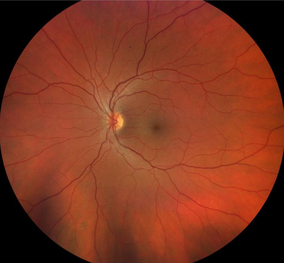 Fond d'Oeil Glaucome