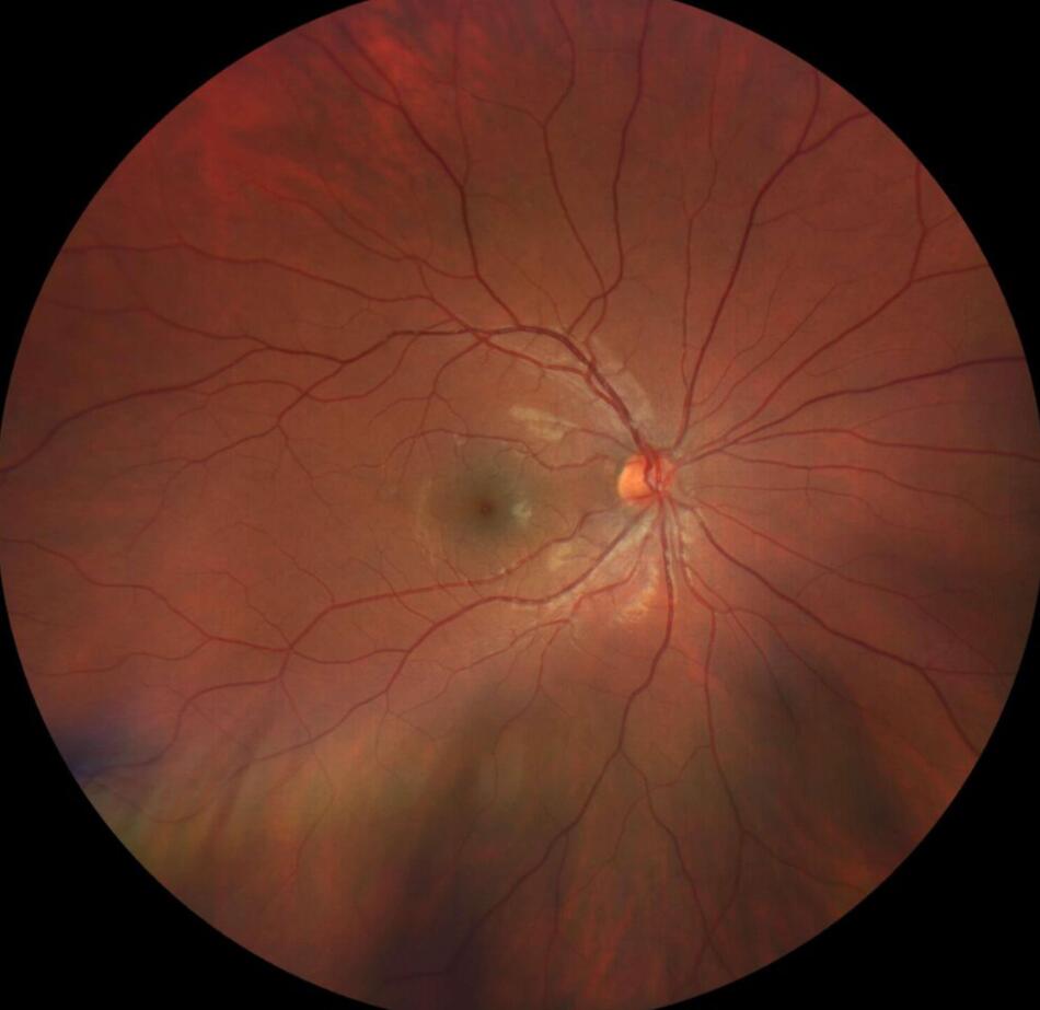 Fond d'Oeil Laser Rétinien